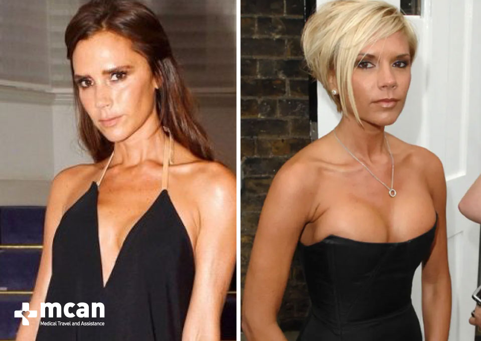 victoria beckham breast