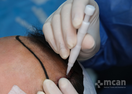 Advantages of DHI Hair Transplant 1