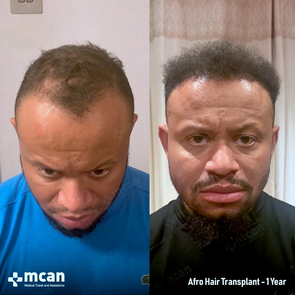 Afro Hair Transplant Results Before After 3