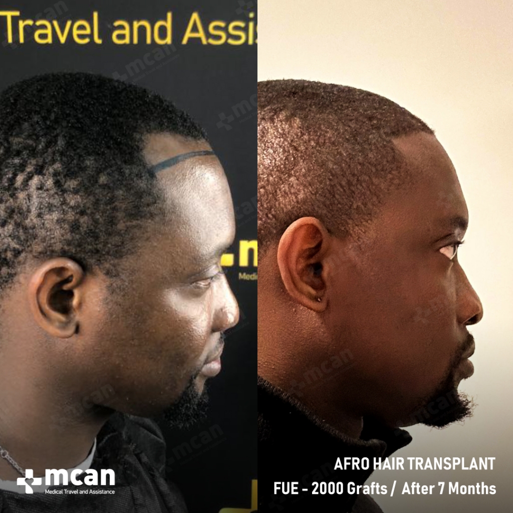 Afro Hair Transplant Results Before After 5