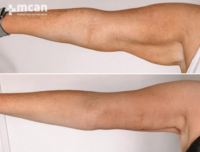 Arm Lift Surgery Results Before After 5