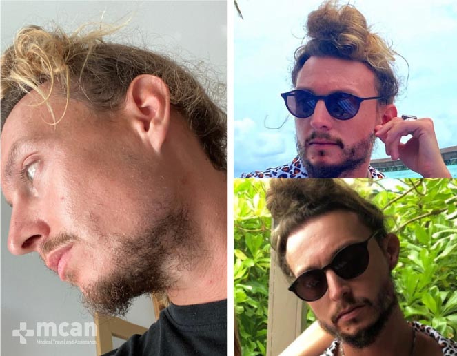 Beard Transplant Results Before After 1