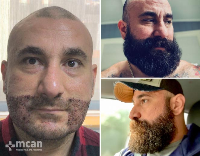 Beard Transplant Results Before After 2