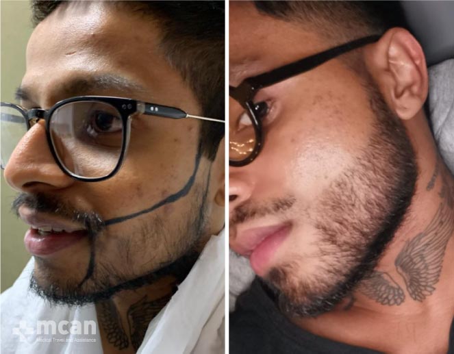 Beard Transplant Results Before After 3