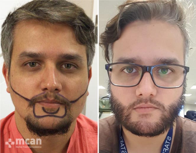 Beard Transplant Results Before After 4