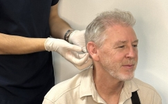 Best Age for Hair Transplant Cover