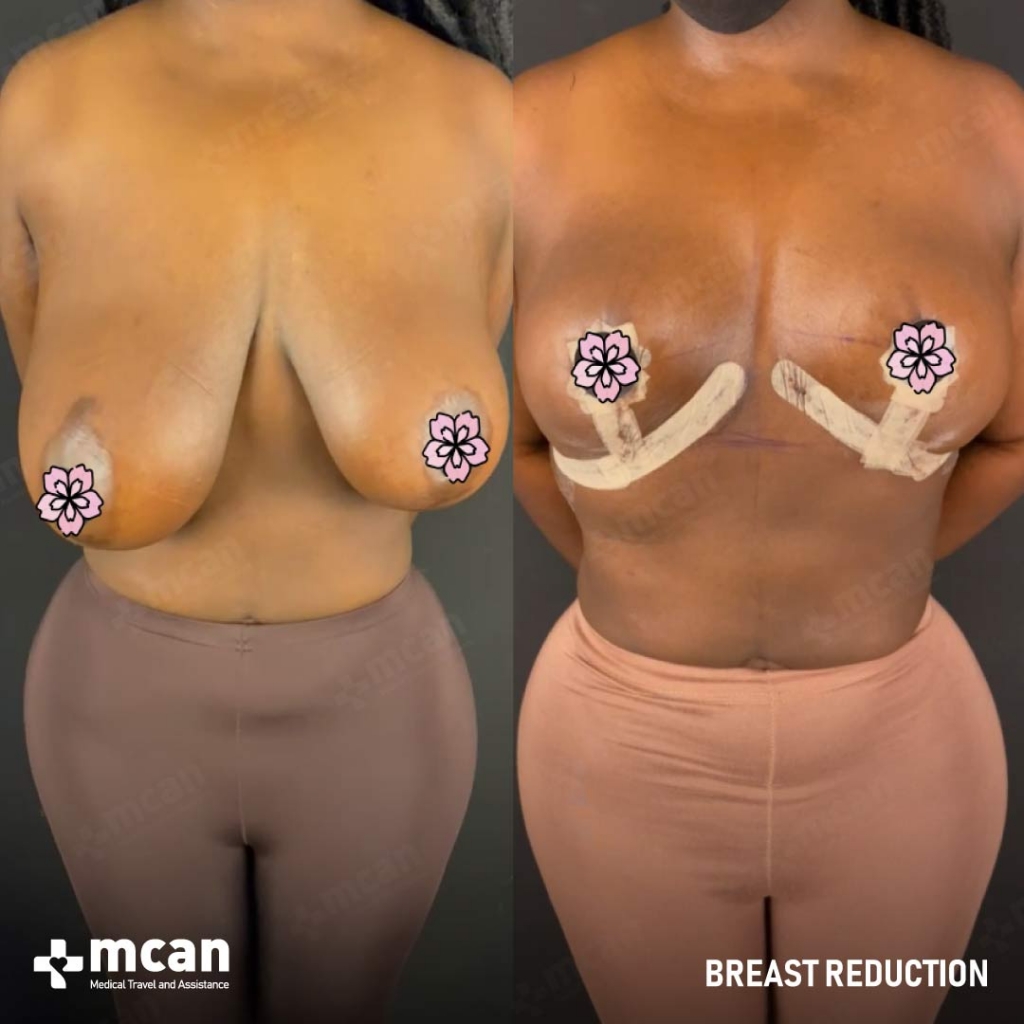 Breast Reduction Results Before After 1