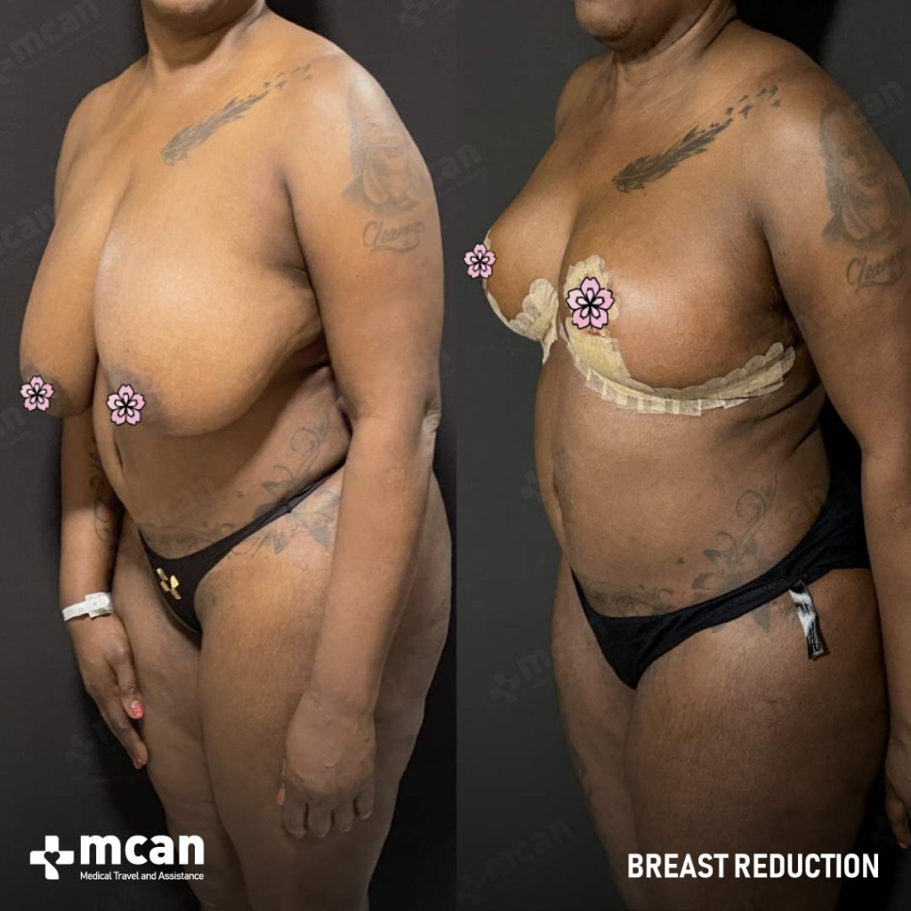 Breast Reduction Results Before After 10