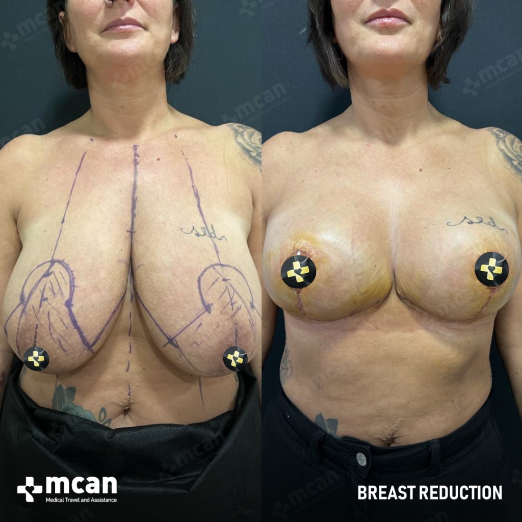 Breast Reduction Results Before After 12