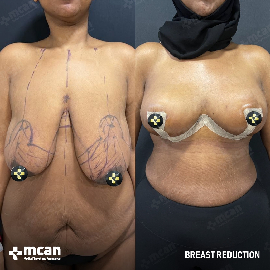 Breast Reduction Results Before After 13