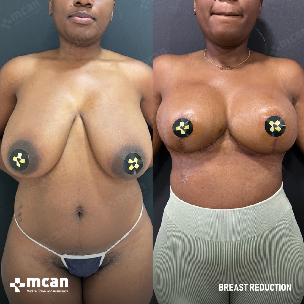 Breast Reduction Results Before After 15