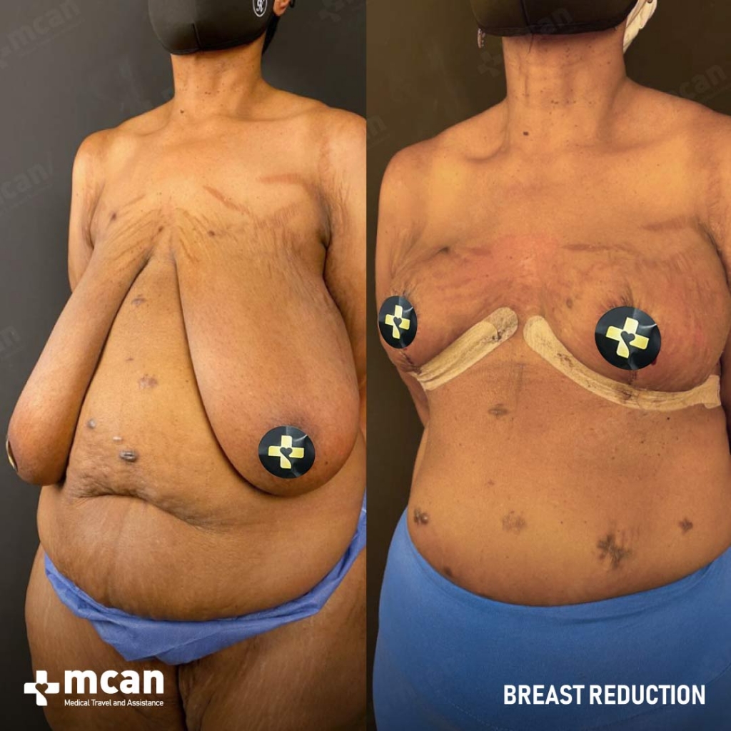 Breast Reduction Results Before After 4