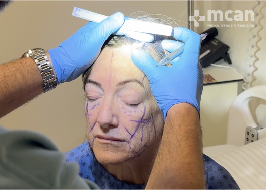 Brow Lift Medical Consultation