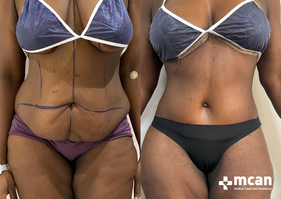 Combining Liposuction and a Tummy Tuck