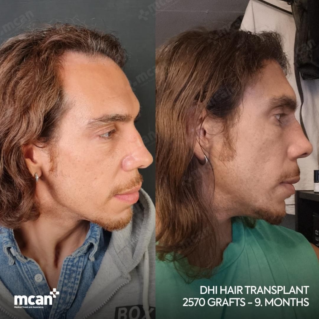 DHI Hair Transplant Results Before After 1