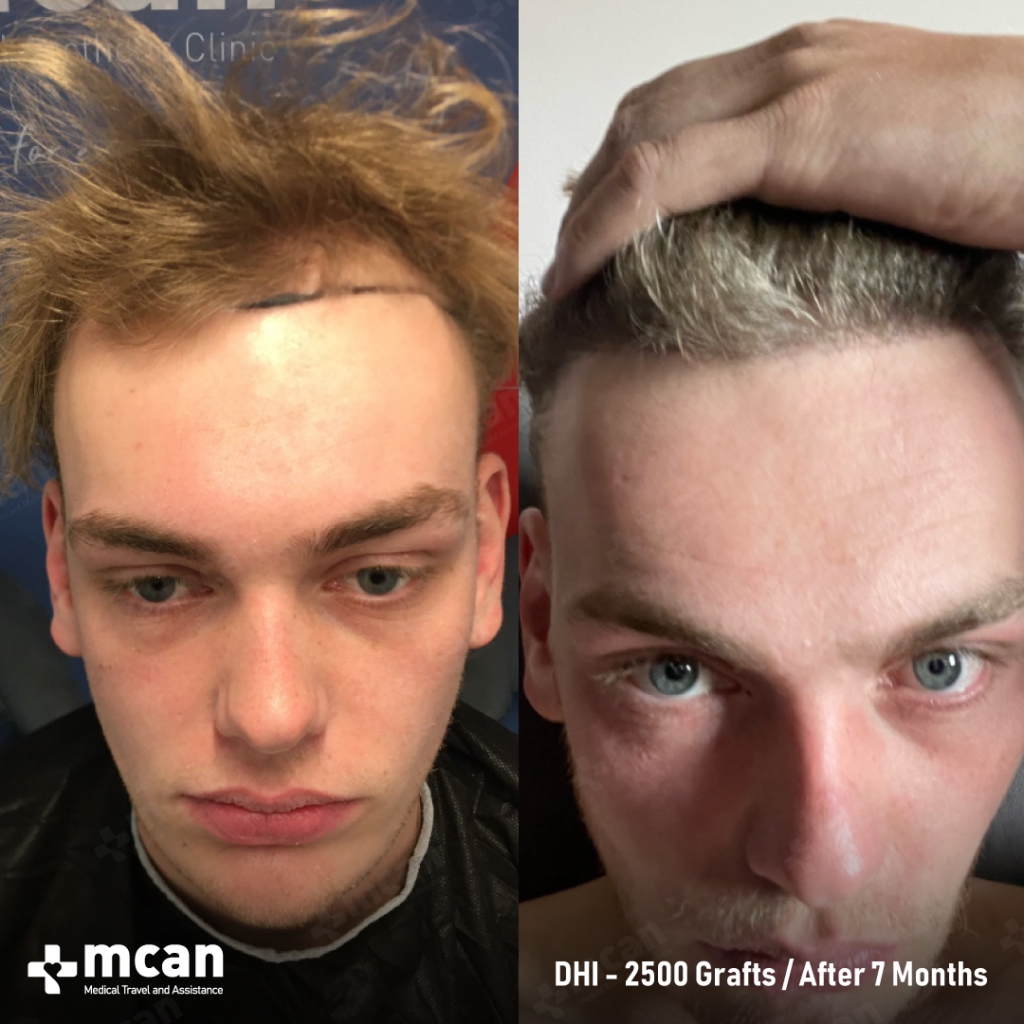 DHI Hair Transplant Results Before After 10