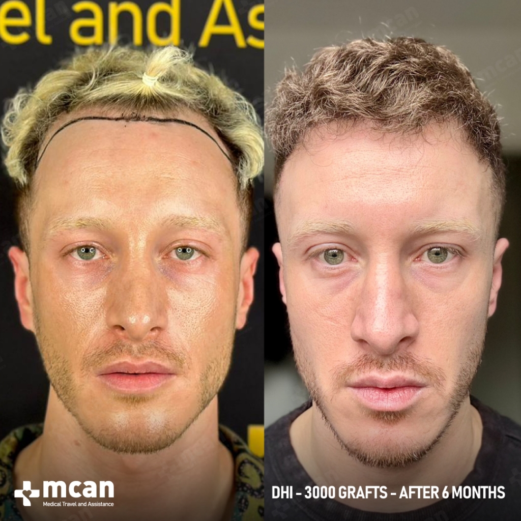 DHI Hair Transplant Results Before After 11 1