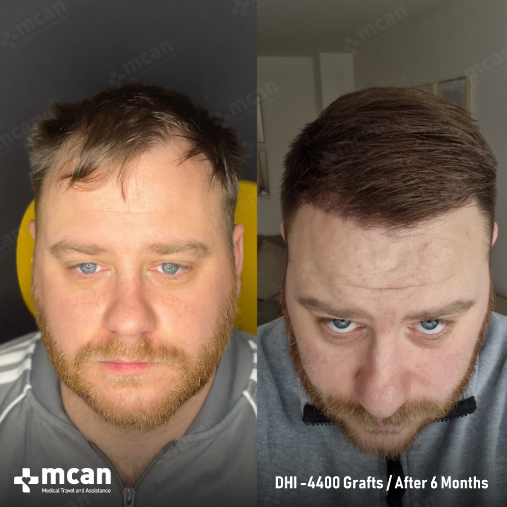 DHI Hair Transplant Results Before After 13