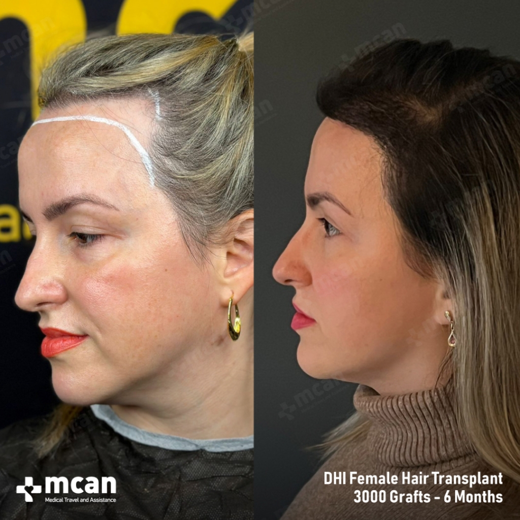 DHI Hair Transplant Results Before After 14