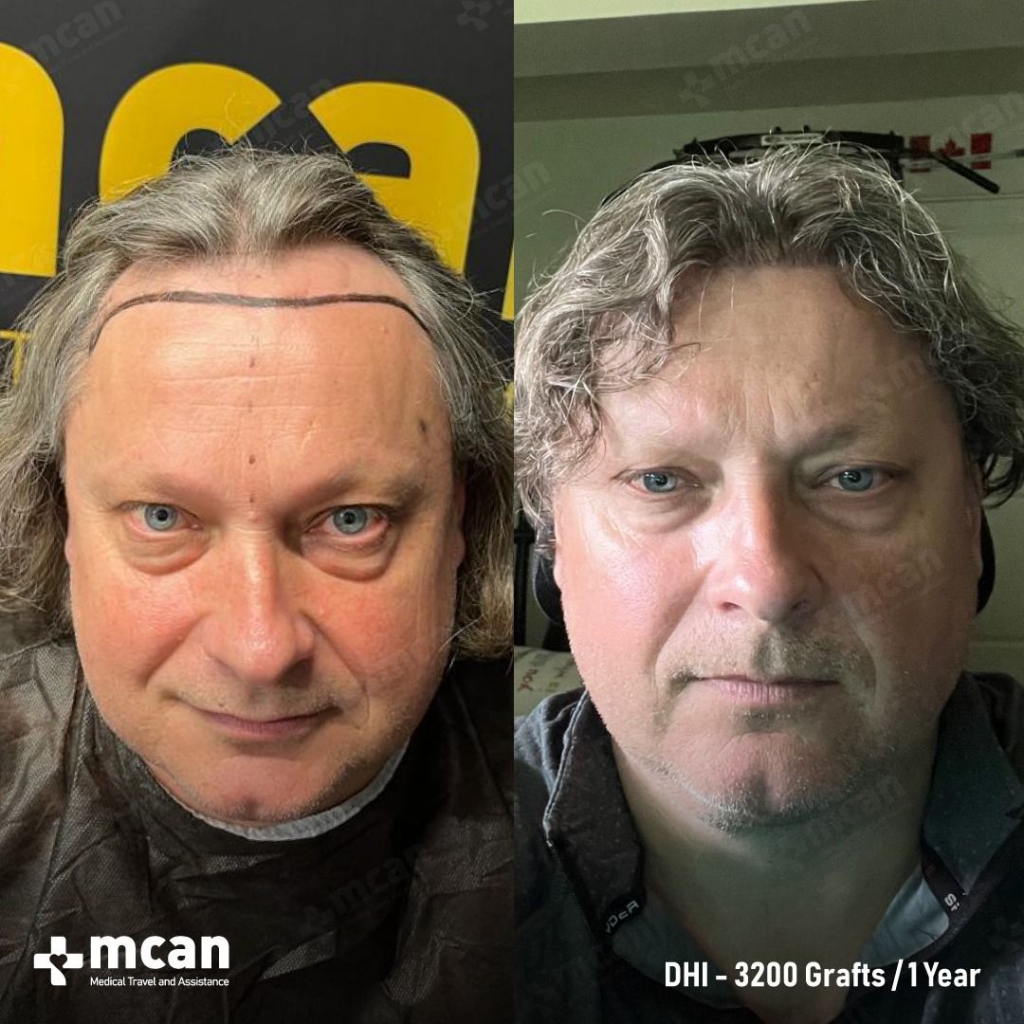 DHI Hair Transplant Results Before After 2