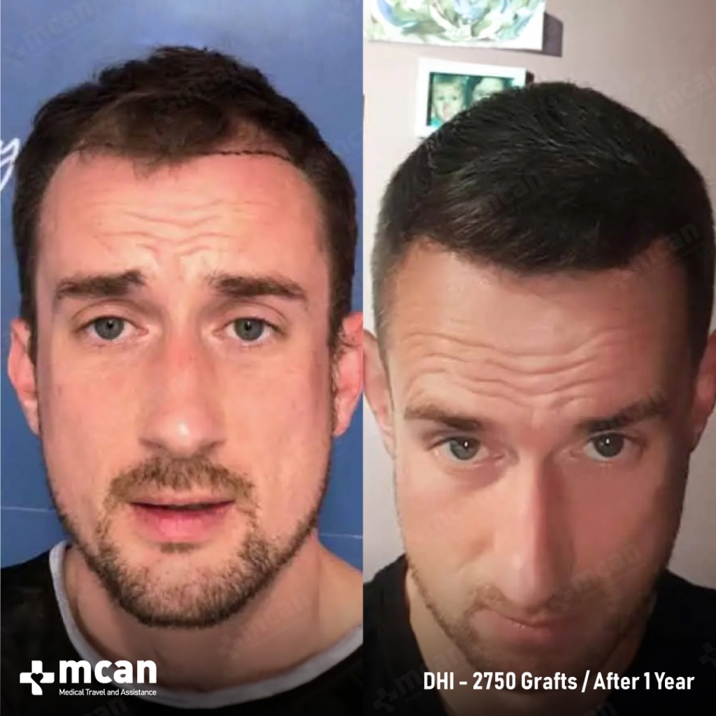 DHI Hair Transplant Results Before After 3