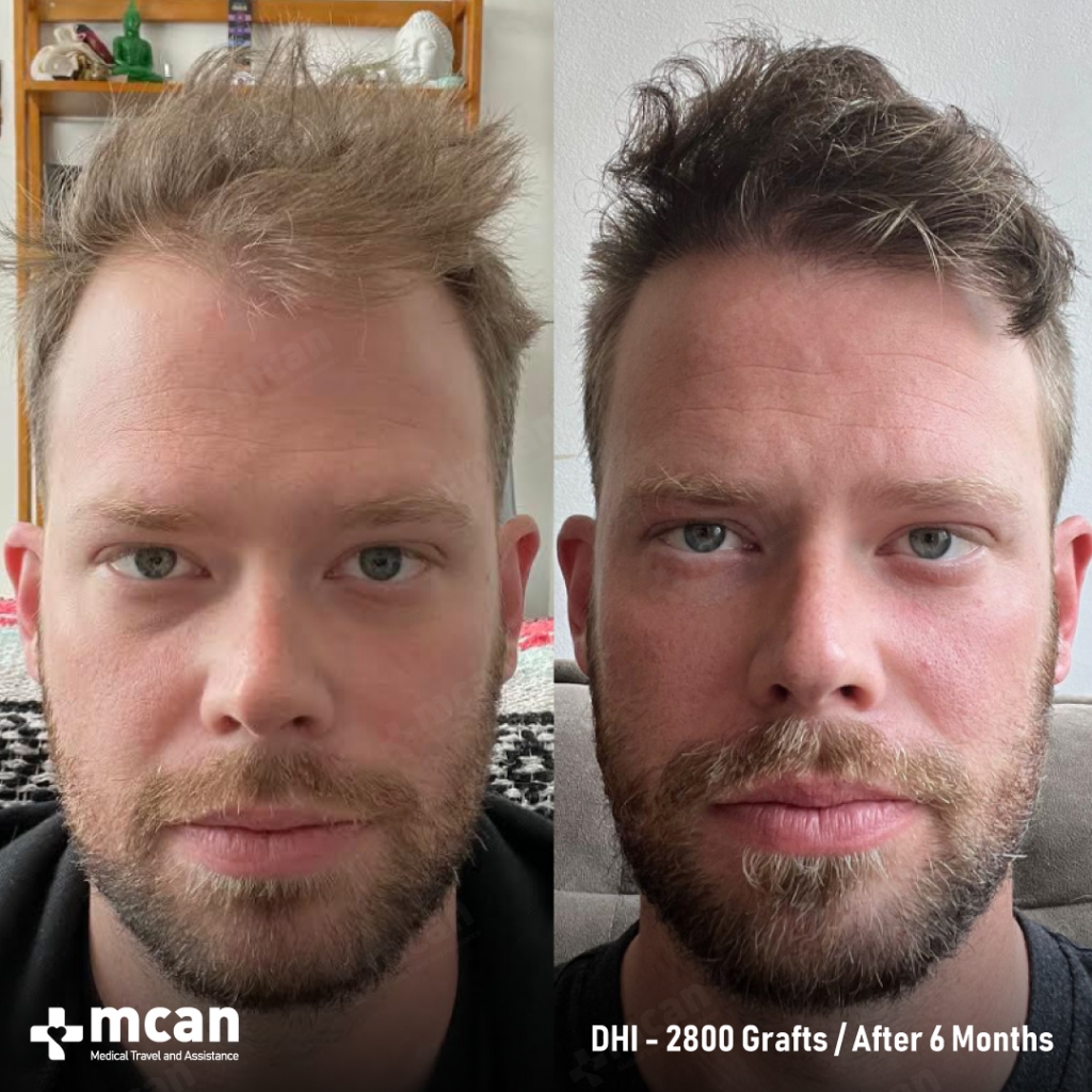 DHI Hair Transplant Results Before After 9