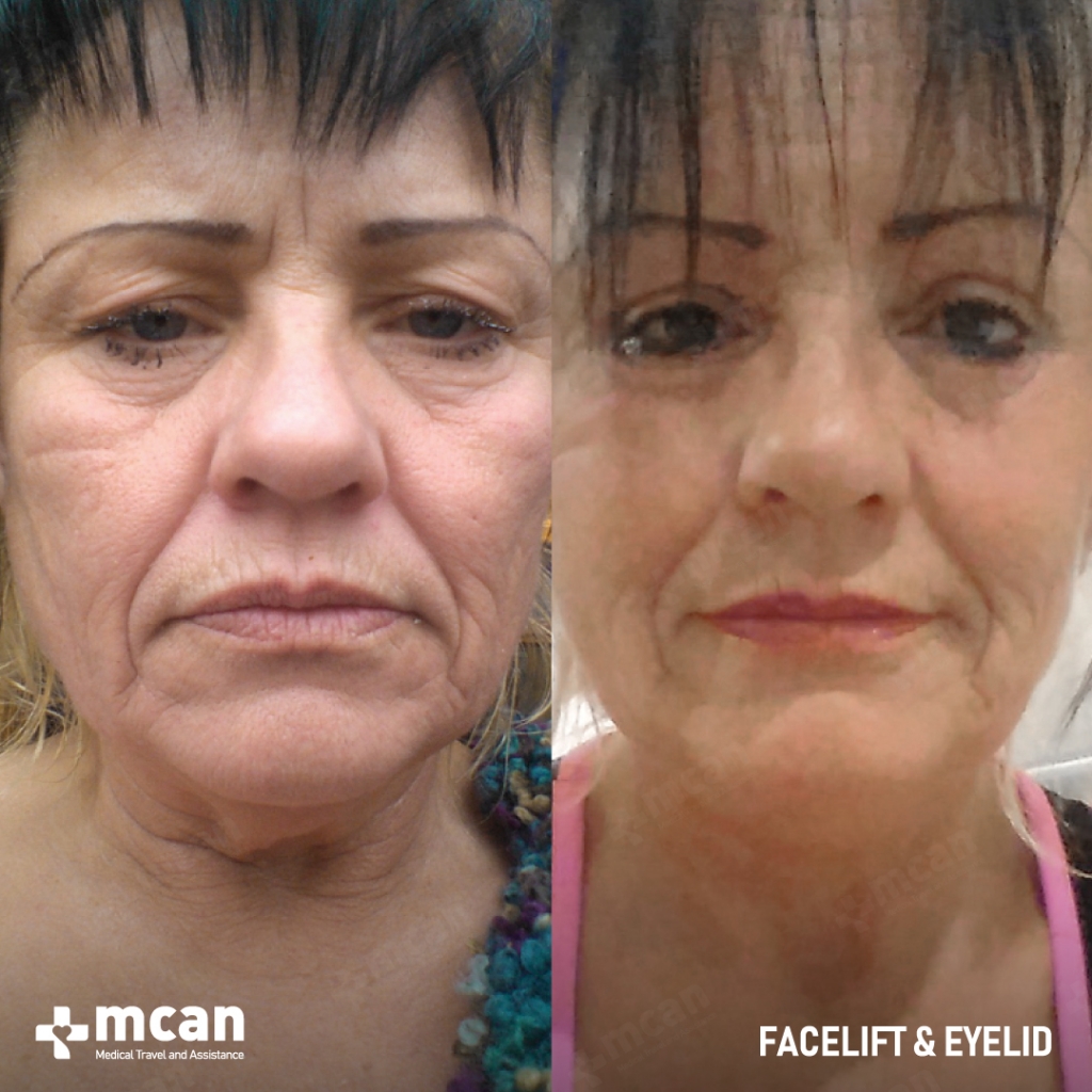 Eyelid Surgery Blepharoplasty Results Before After 10