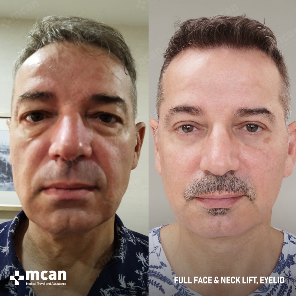 Eyelid Surgery Blepharoplasty Results Before After 5