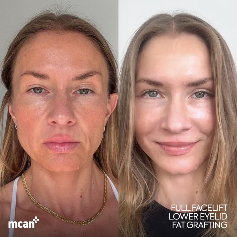 Facelift Before & Afters 1