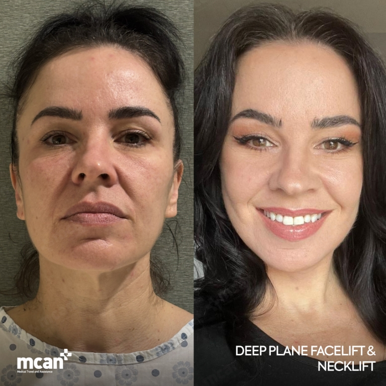 Lifting Facial Antes y Despues  1