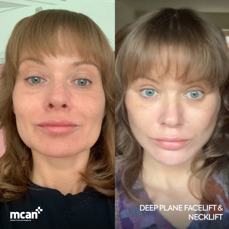 Facelift Before & Afters  1