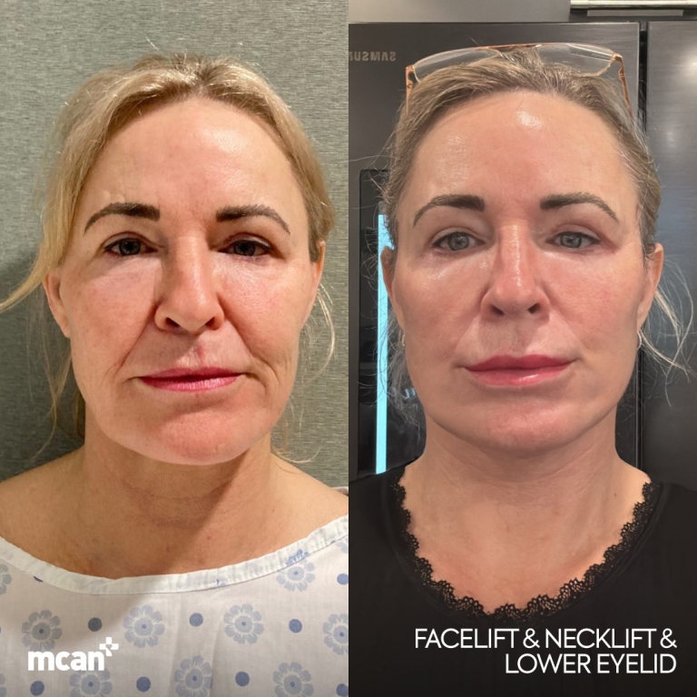 Facelift Before & Afters  1