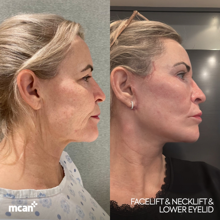 Facelift Before & Afters  2