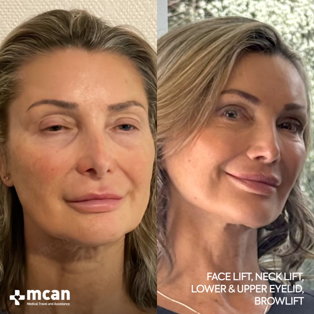 Facial Rejuvenation Results Before After 12