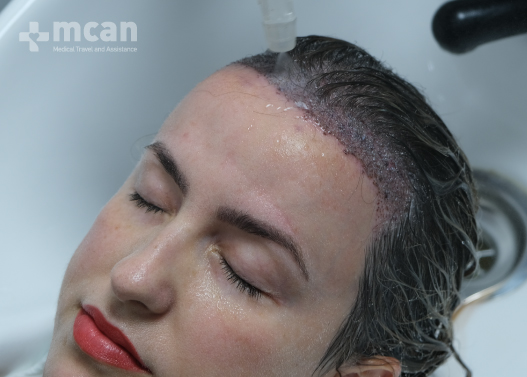 Female Hair Transplant Aftercare