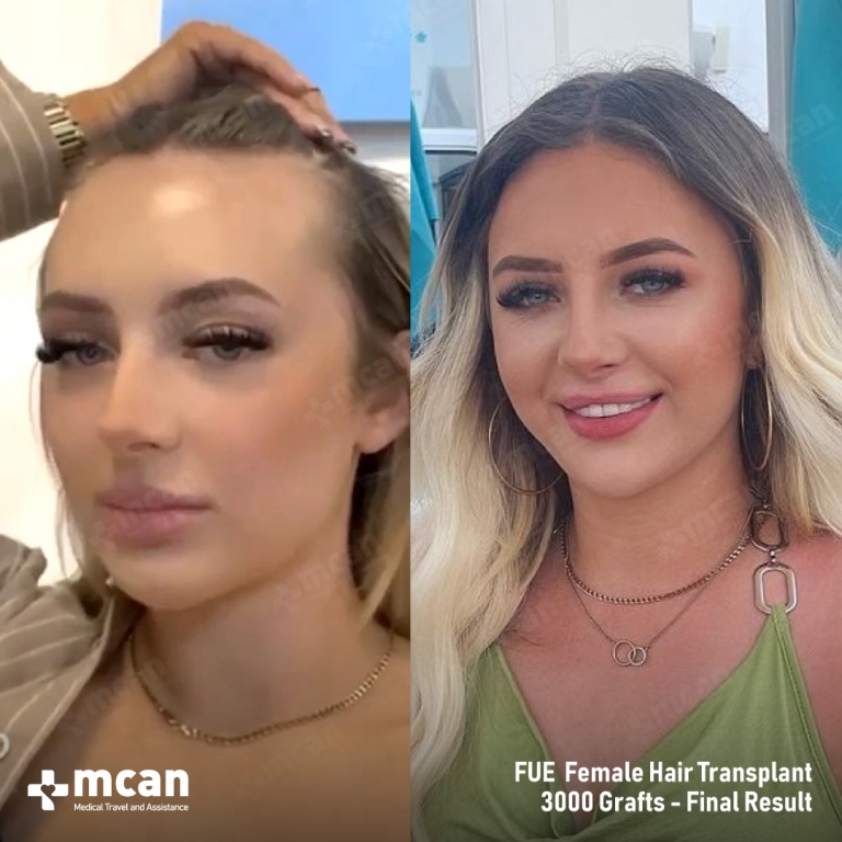 Female Hair Transplant Results Befoe After 2