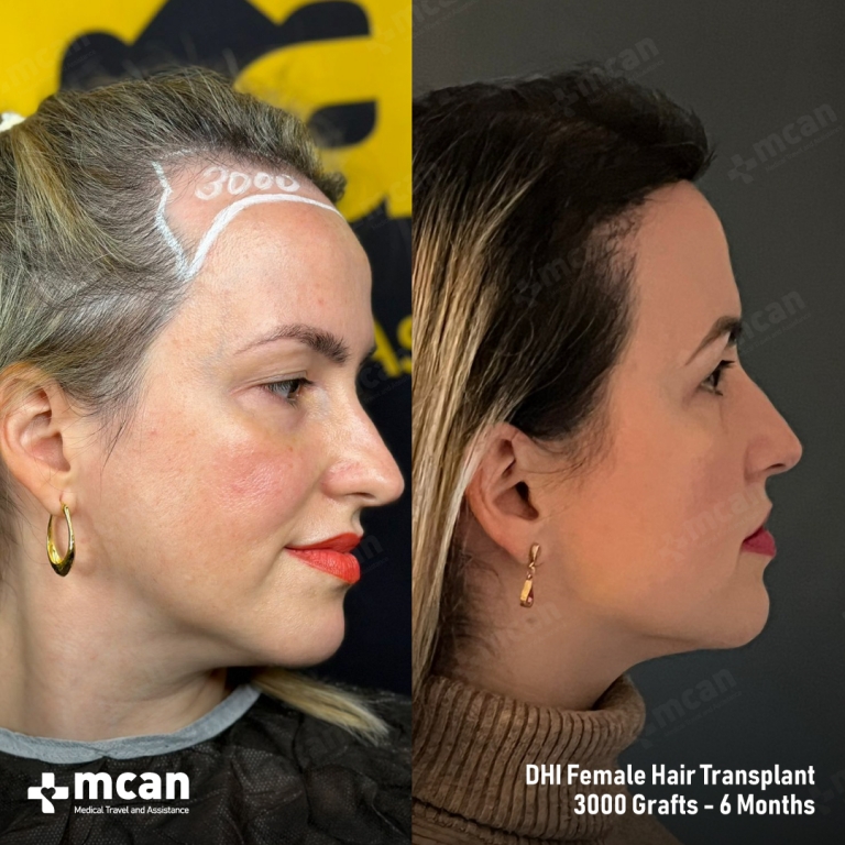 Female Hair Transplant Results Befoe After 5