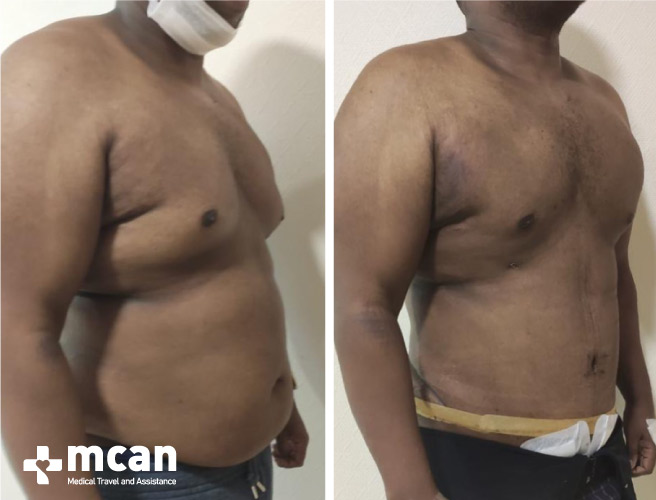 Gynecomastia Surgery Results Before After 4