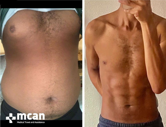 Gynecomastia Surgery Results Before After 7