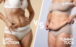 Liposuction vs. Tummy Tuck