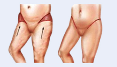 Outer Thigh Lift Lateral Thigh Lift