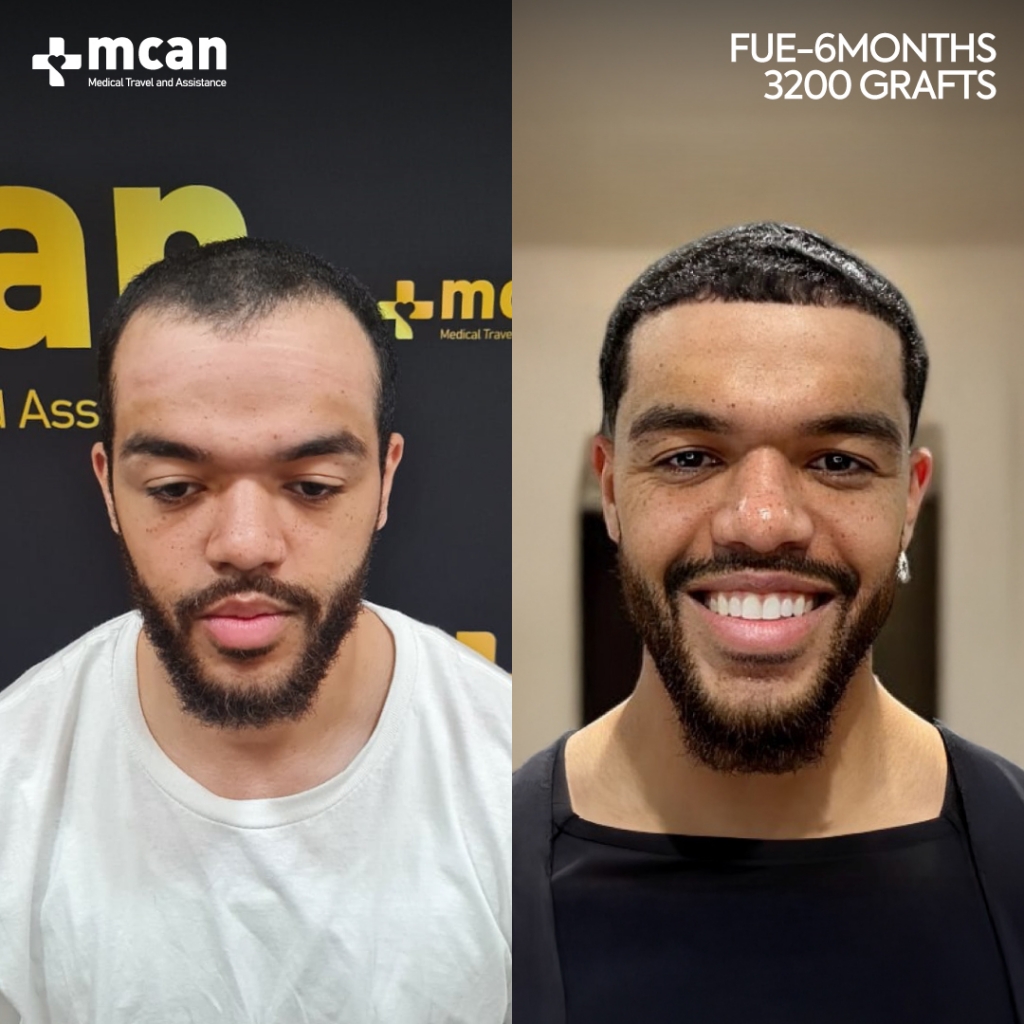 Sapphire FUE Hair Transplant Results Before After 1