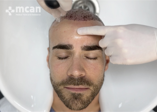 Sapphire Hair Transplant Aftercare