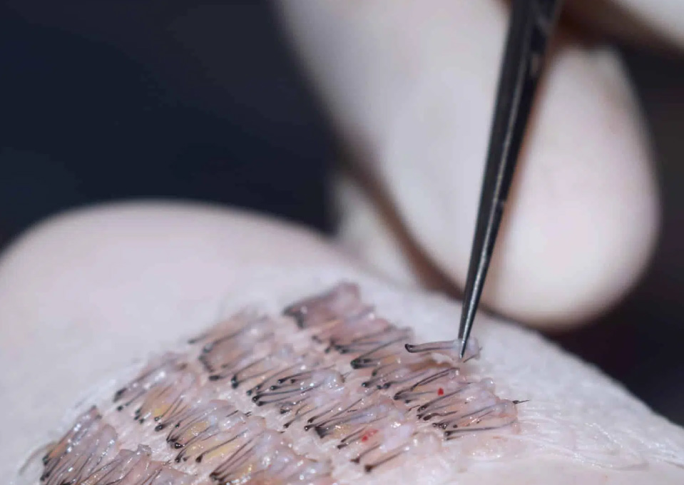 What Is a Graft in Hair Transplant