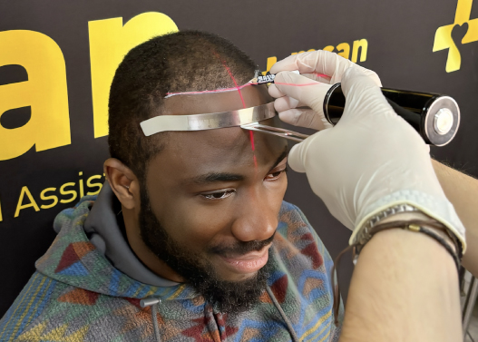 What is Afro Hair Transplant