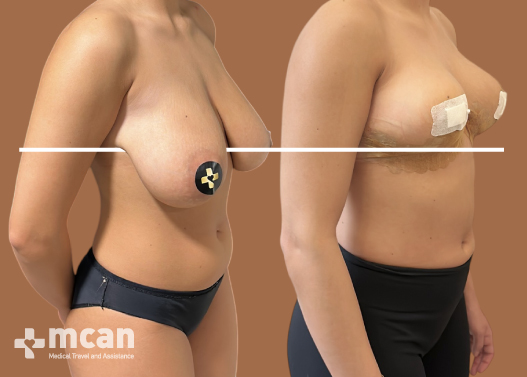 What is Breast Reduction