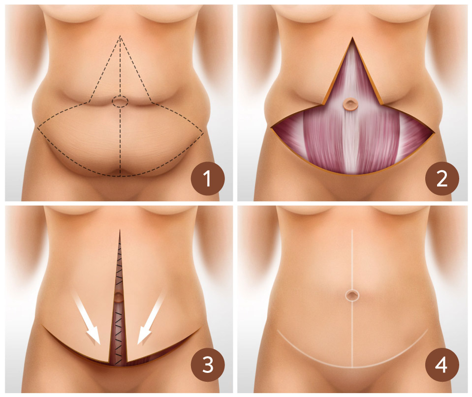 What is a Fleur de Lis Tummy Tuck