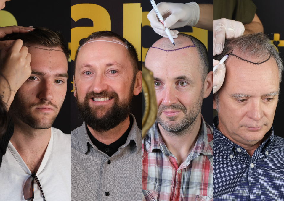 Whats the Best Age for a Hair Transplant A Breakdown by Age Group