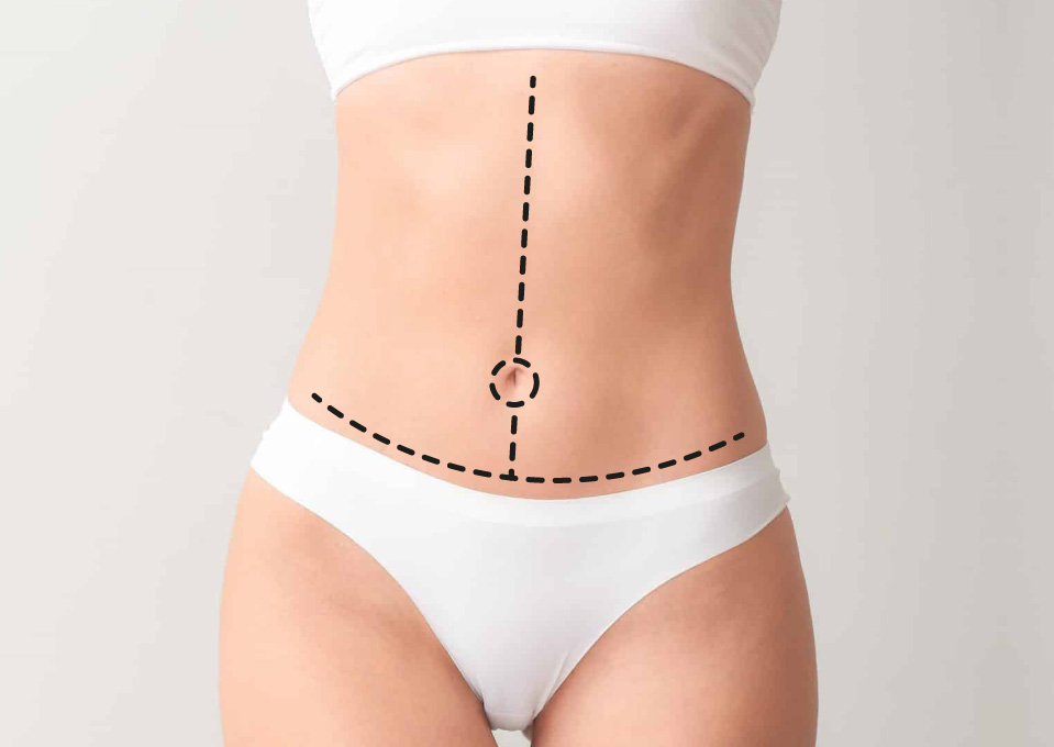 Where Are the FDL Tummy Tuck Scars Located