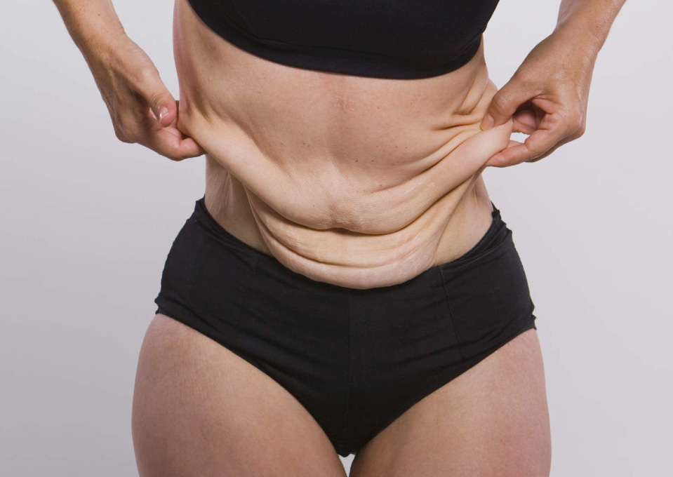 Who is a Good Candidate for a Fleur de Lis Tummy Tuck